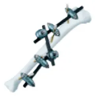 骨折治療材料の画像