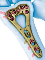 骨折治療材料の画像